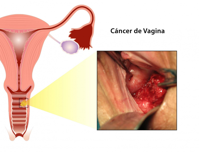 Vulva reconstruction surgery pictures