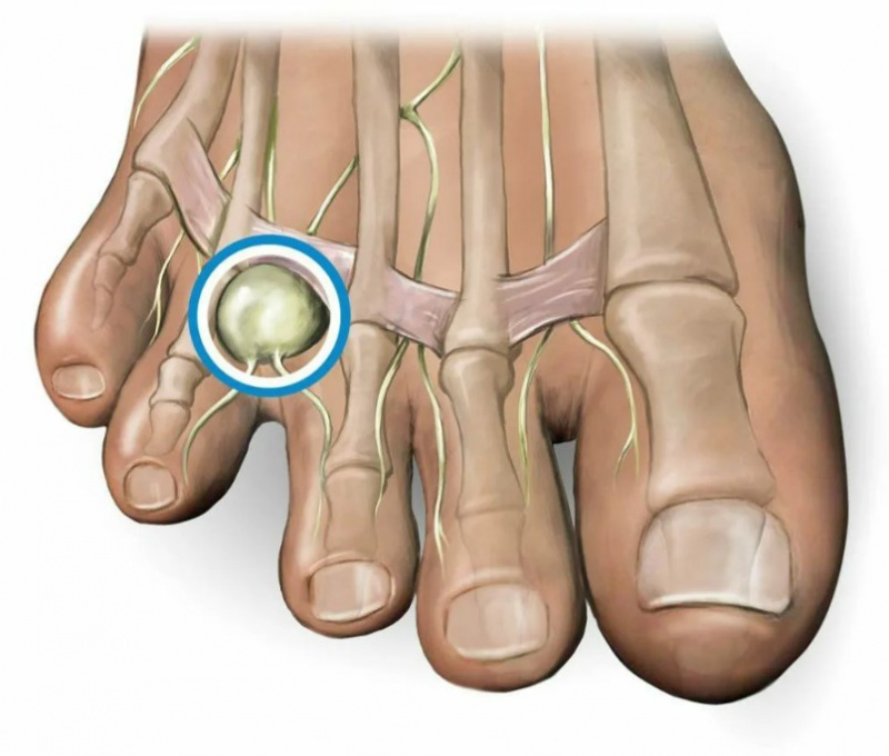 Доброкачественная опухоль подошвенного нерва, которая доставляет боль во время спорта: боль между 2-3-4 пальцами на ноге
