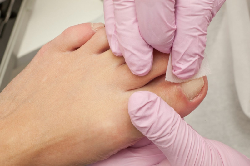 Что делать при первых симптомах врастания ногтя
