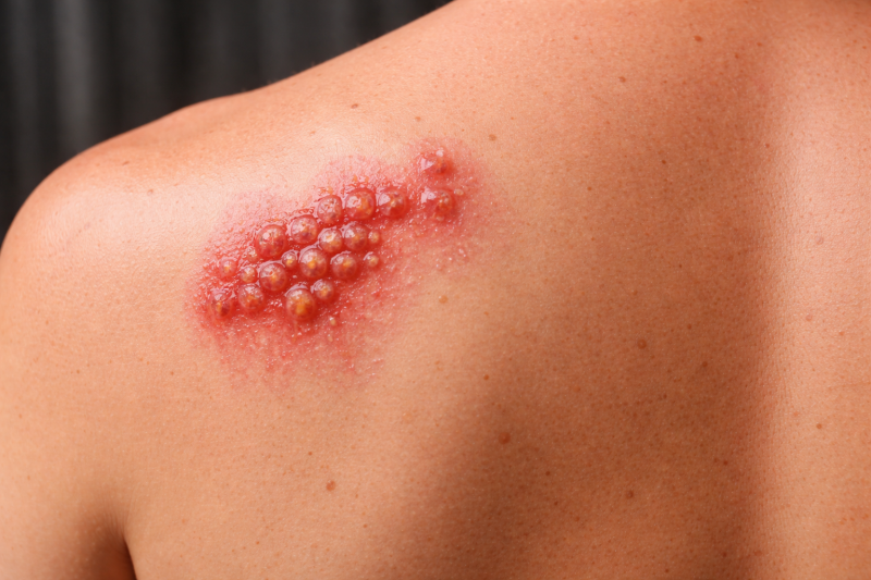 Герпес на спине (опоясывающий лишай): симптомы, лечение и когда нужна помощь врача