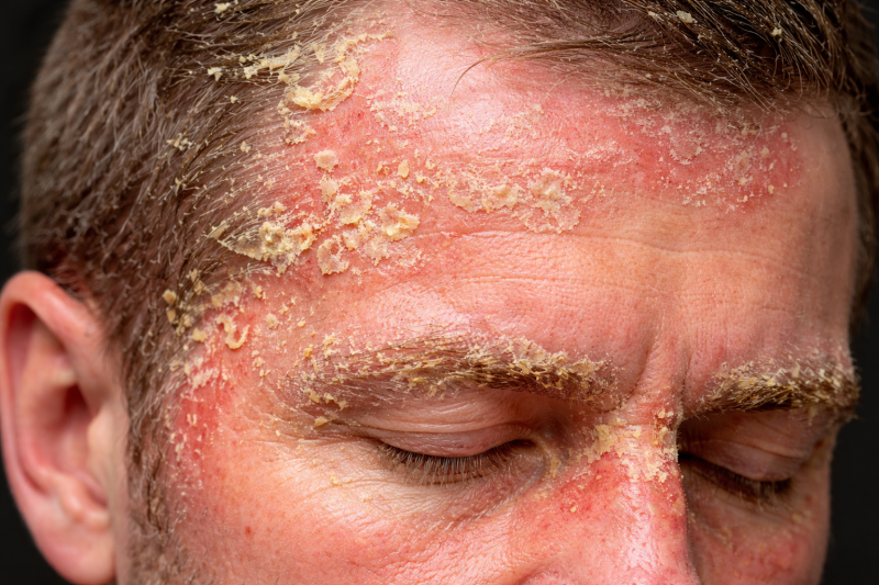 Себорейный дерматит и алопеция: как воспаление кожи головы влияет на волосы и что помогает