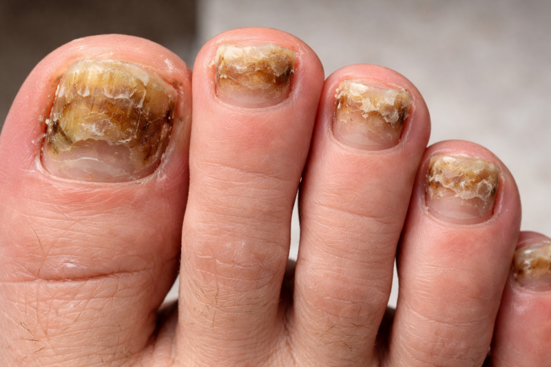 Грибок ногтей: от первых признаков до быстрого восстановления ногтевой пластины