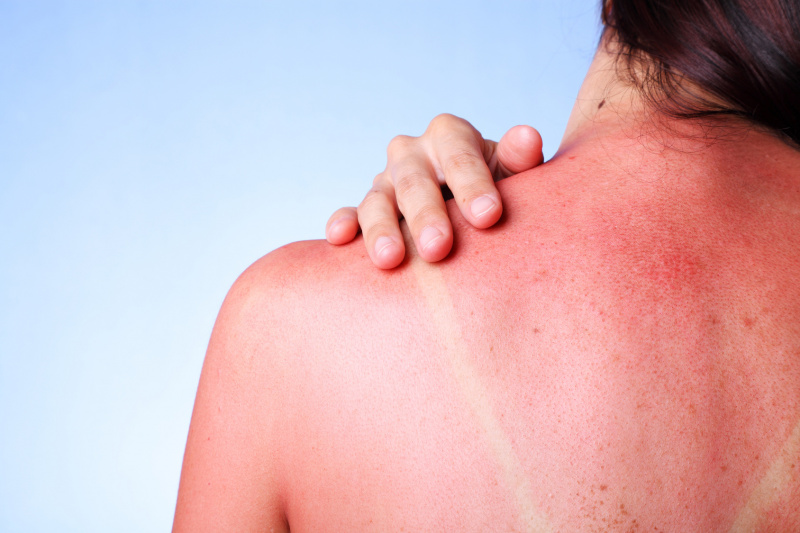 Аллергия на солнце: симптомы, лечение