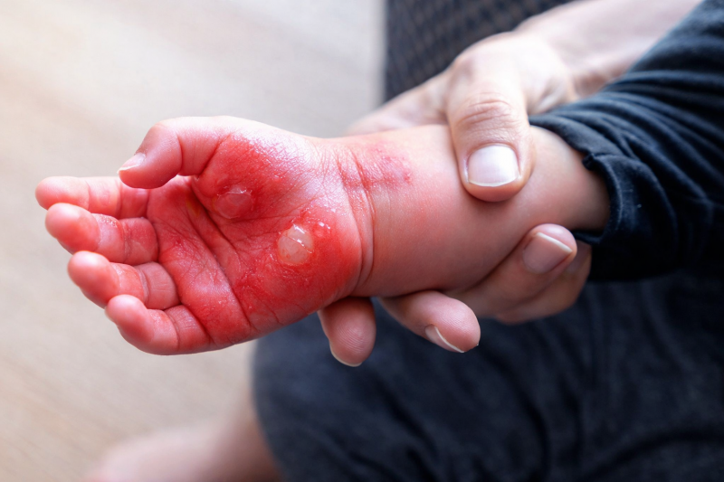 Ожоги у детей: как распознать, что делать и когда обращаться к врачу