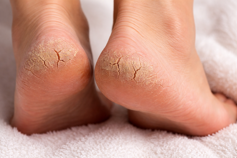 Что вызывает трещины на пятках и как их лечить: причины, уход и медицинская помощь