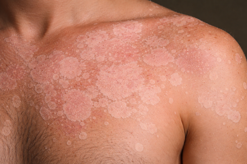 Разноцветный лишай: причины и факторы риска, как распознать и предупредить заболевание