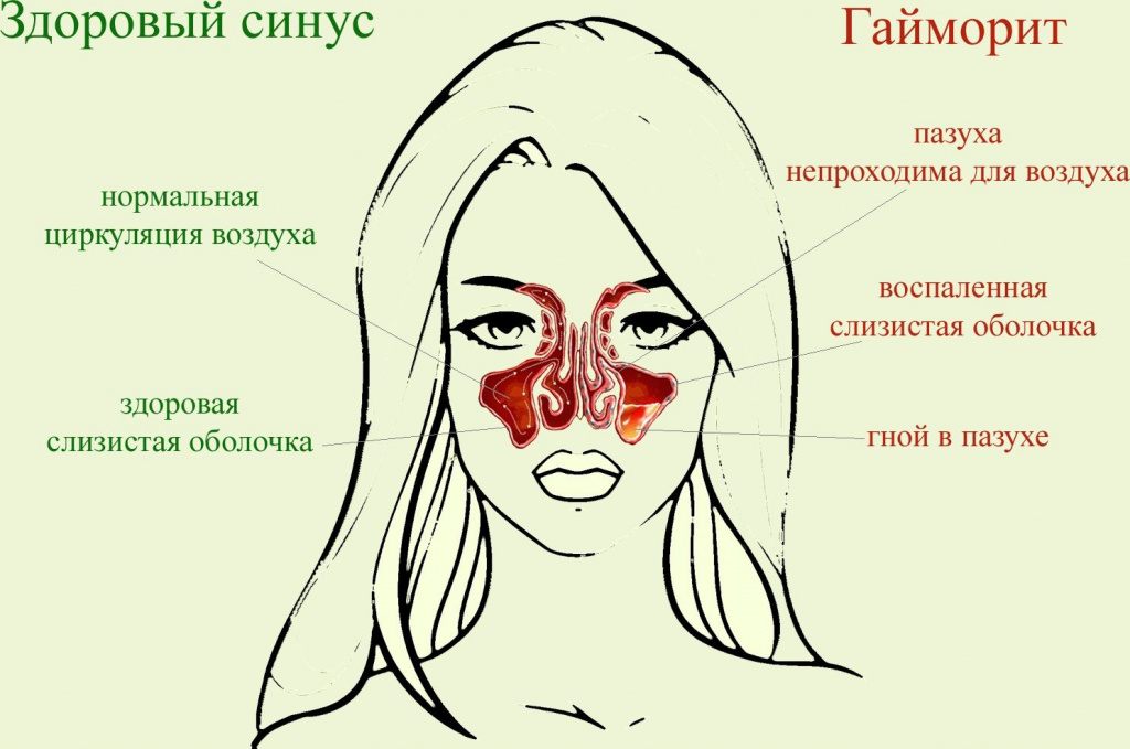 Гайморит - симптомы, причины, лечение и профилактика у взрослых и детей