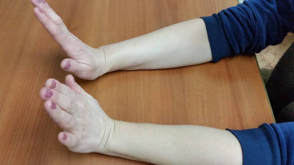Переломы лучевой кости руки в типичном месте