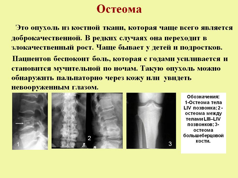 osteoma#2.jpg
