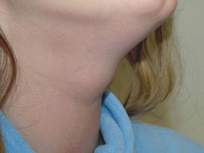 Увеличенные лимфоузлы на шее у детей. Что делать?