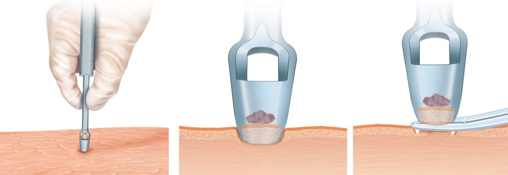 HOW-PAINFUL-IS-SURGICAL-MOLE-Punch-Biopsy-By-ilusmedical-1536x531.jpg