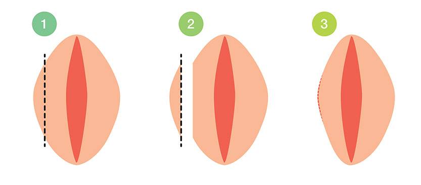 Женские малые половые губы. Пластическая операция лабиопластика. Малые половые губы лабиопластика. Лабиопластика больших и малых половых губ. Лабиопластика уменьшение половых губ.