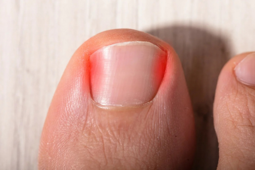Вирус Коксаки: лечение ногтей
