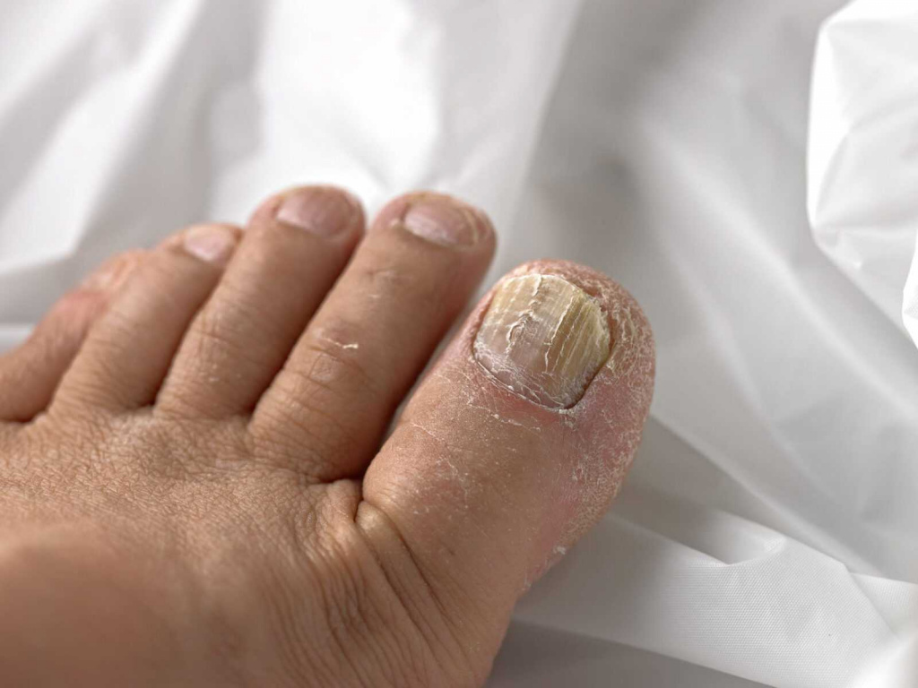 Лечение грибка ногтей чистотелом в домашних условиях