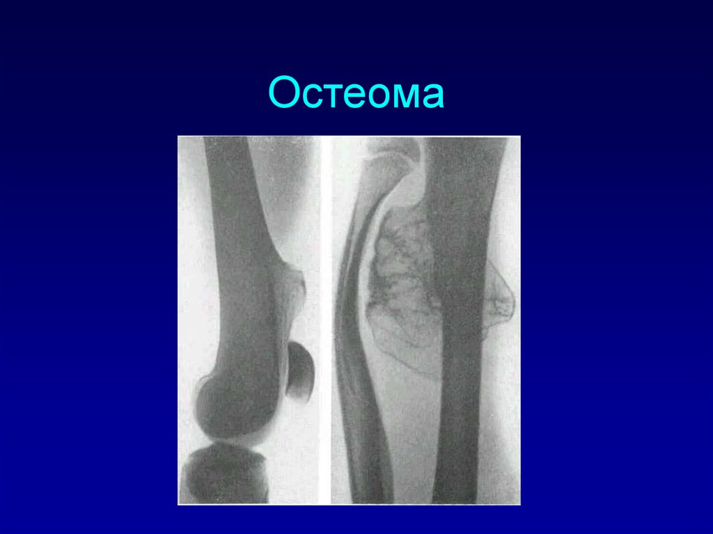 osteoma#3.jpg
