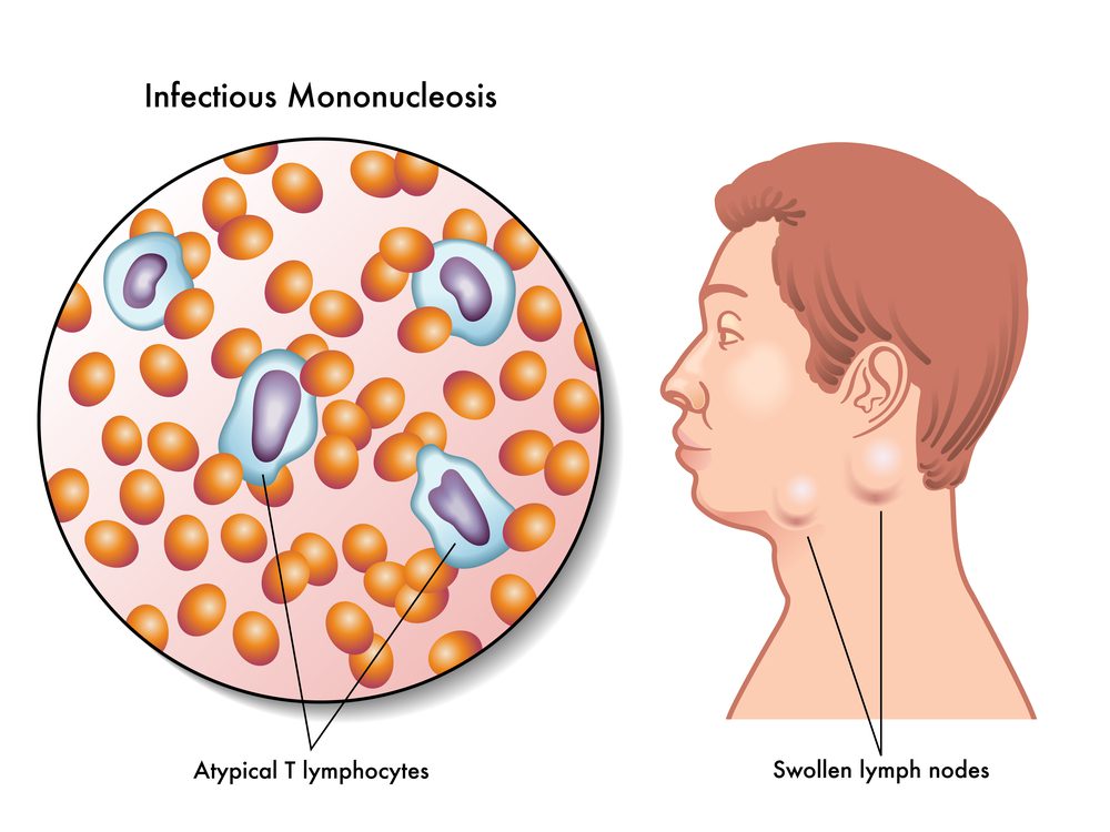 Mono-Infectious-Mononucleosis.jpg