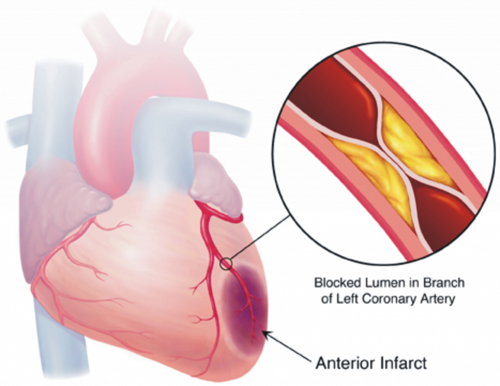 myocardial-ischemia-11.jpg