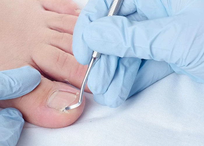 Хирургическое лечение вросшего ногтя