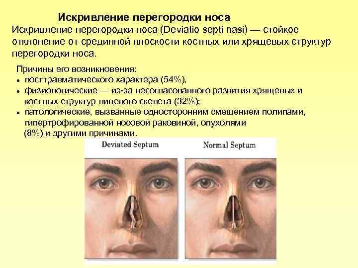 Причины и признаки искривления носовой перегородки