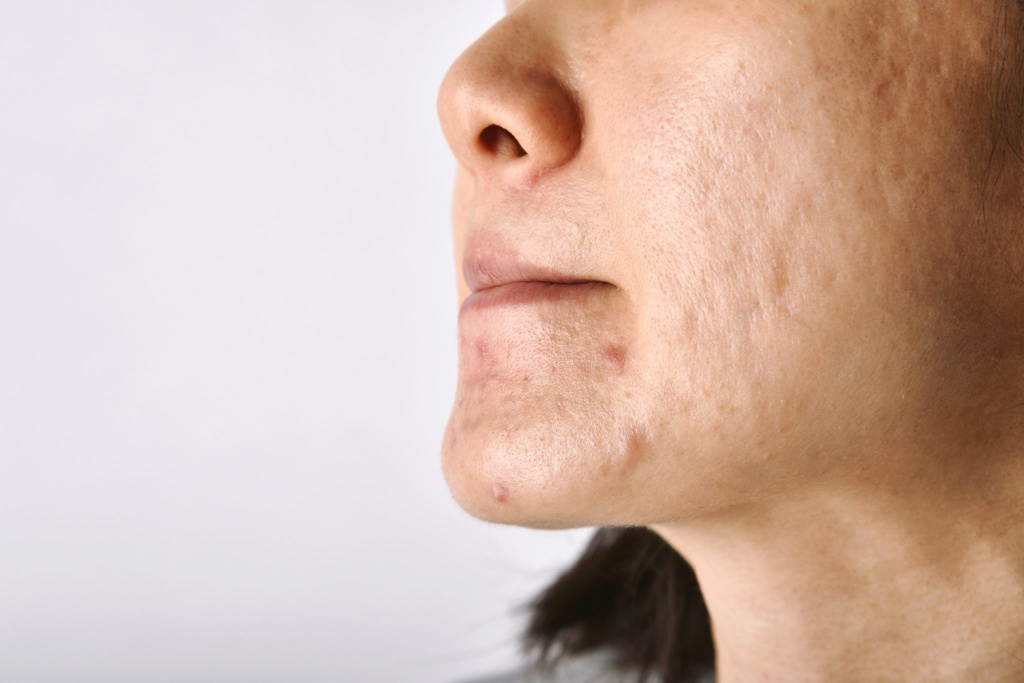 skin-problem-with-acne-diseases-5BEB89K-2048x1366.jpg