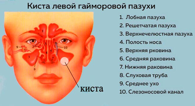 Киста в носу. Диагностика и лечение кист придаточных пазух носа