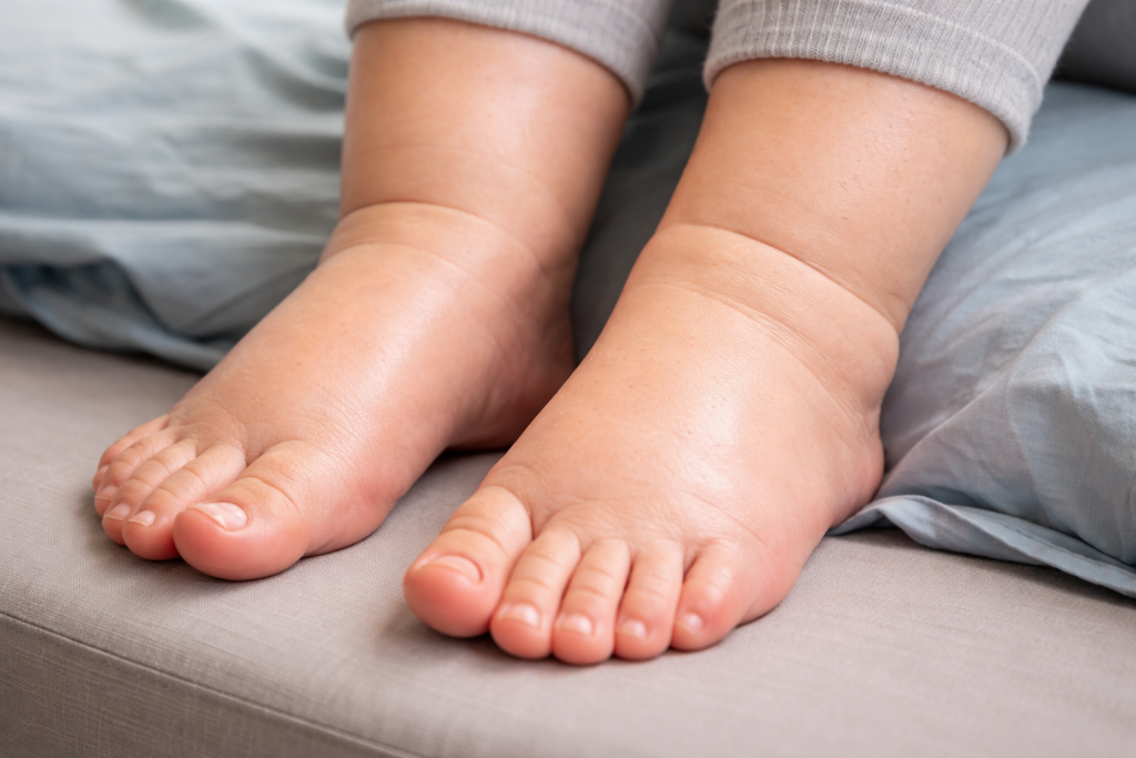 отечность.png отечность.png