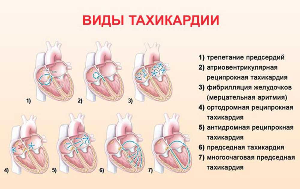 Признаки тахикардия у женщины симптомы. Тахикардия и другие заболевания сердца. Лечится ли тахикардия сердца. Тахикардия сердца что это такое и как лечить. Усиление сердцебиения.