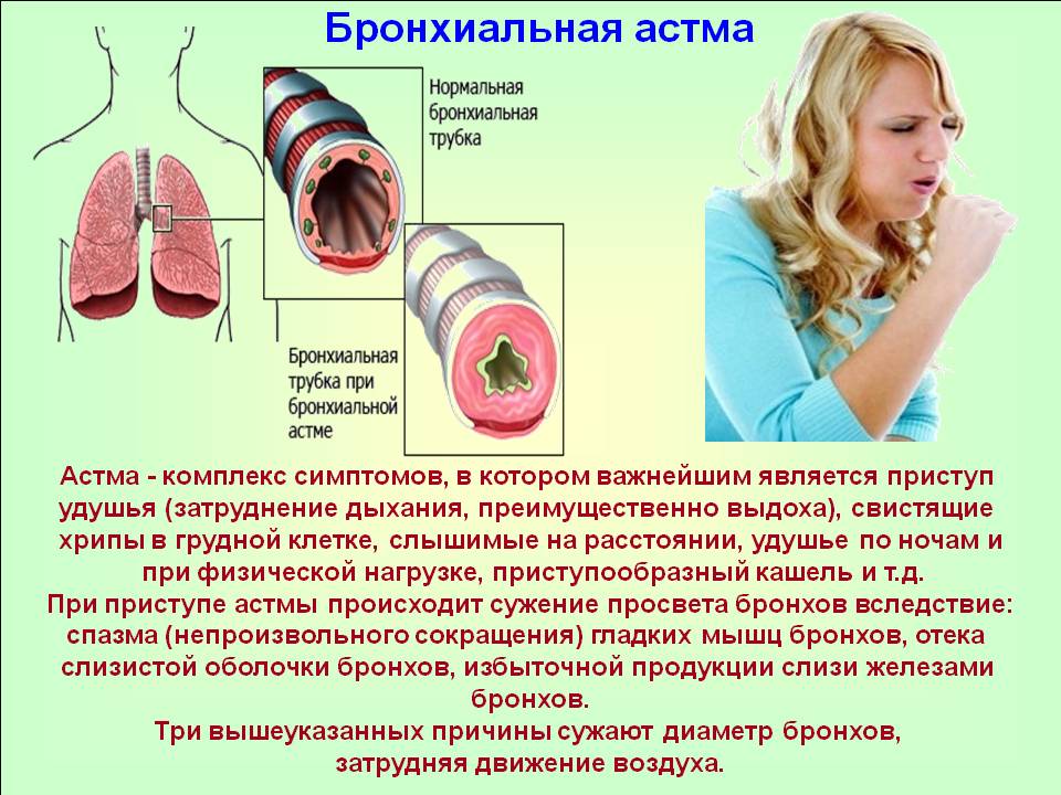 Лечение бронхиальной астмы