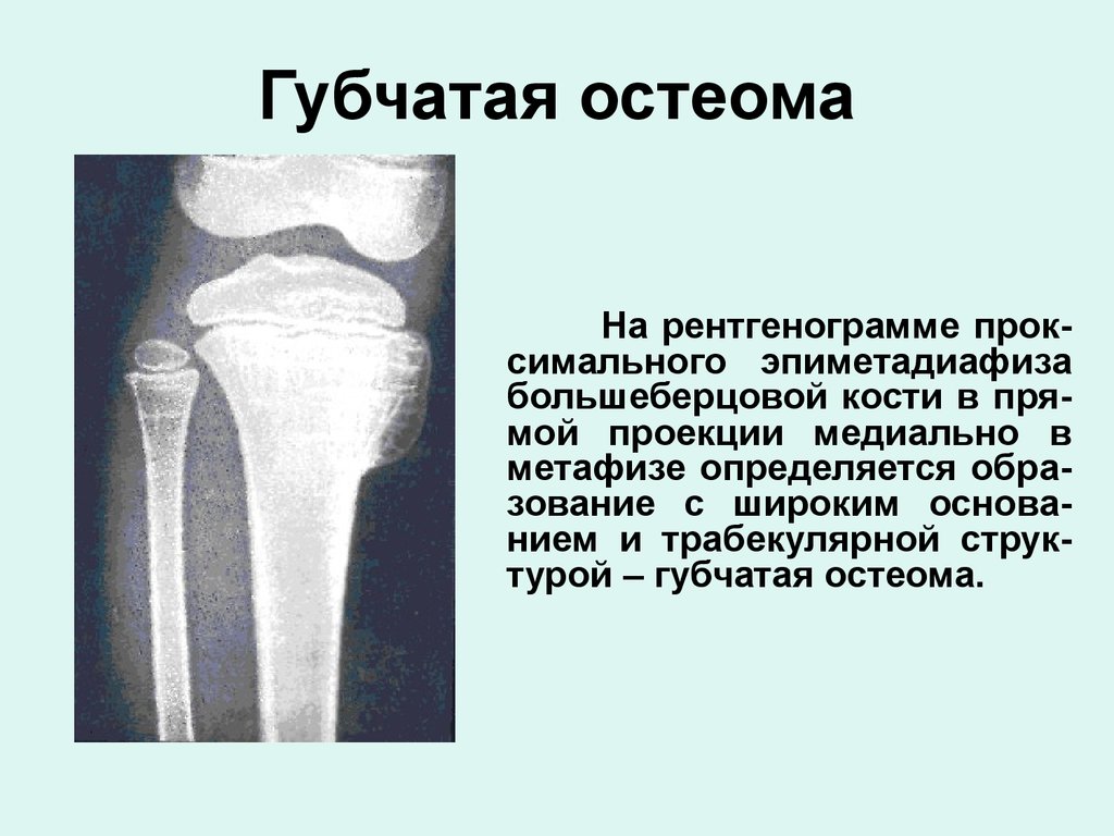 osteoma#4.jpg