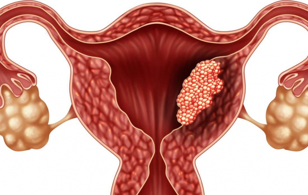 endometr#3.jpg