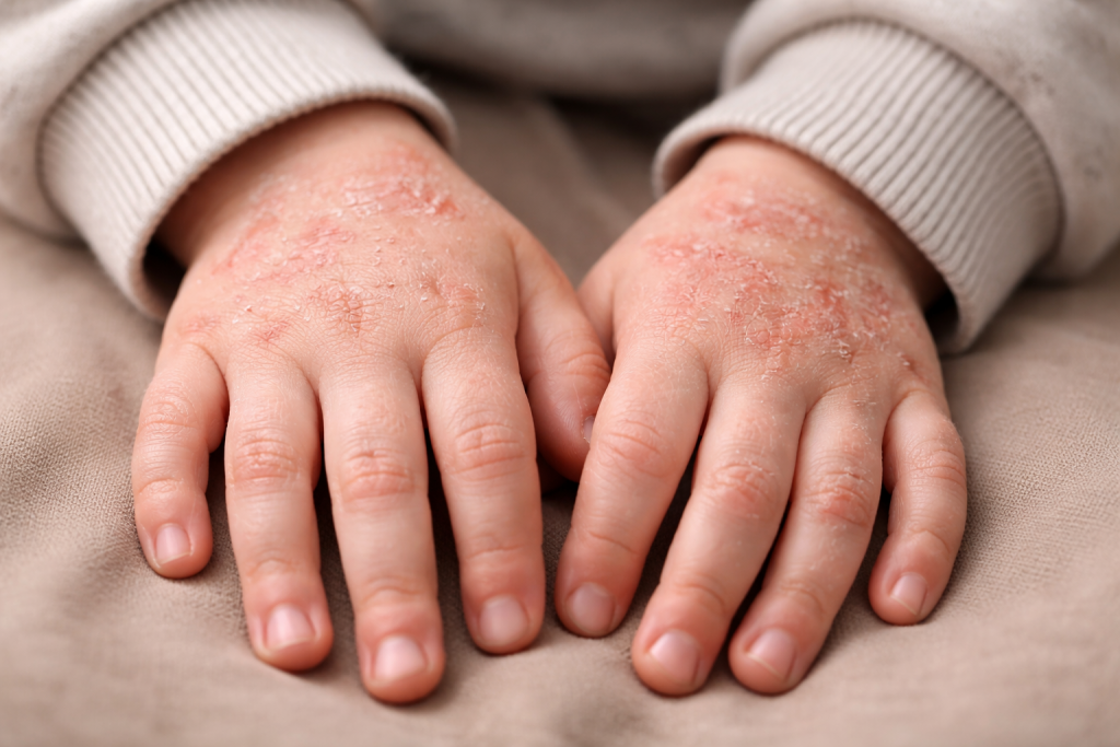 аллергия сухость раздражение.png