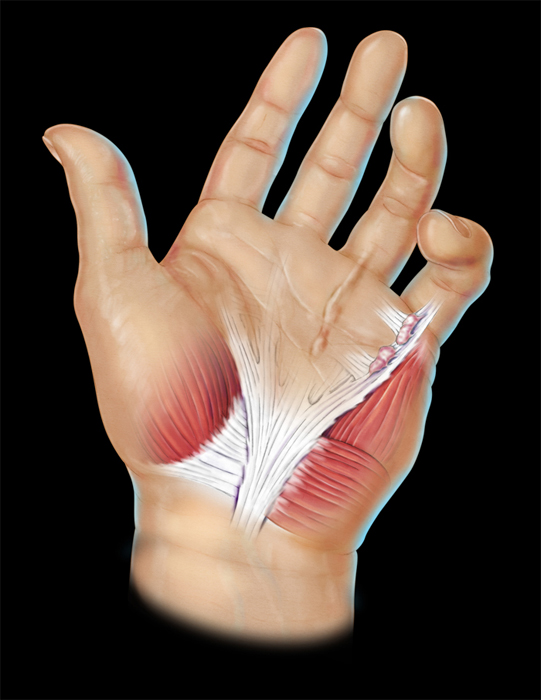 Dupuytrens-Contracture.jpg