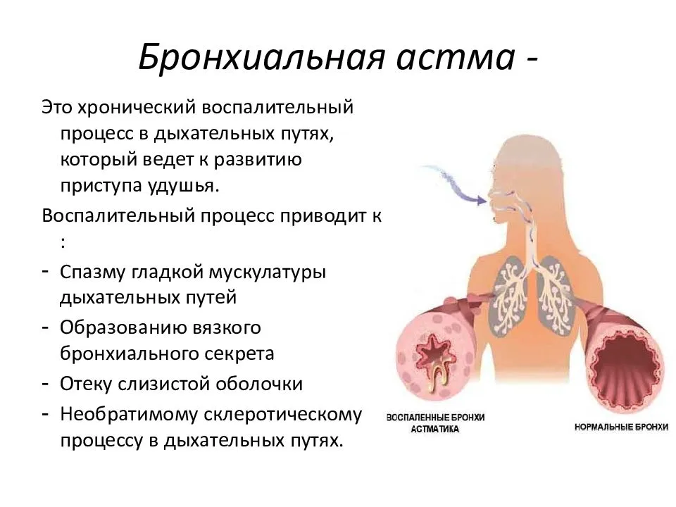 astma#4.jpg
