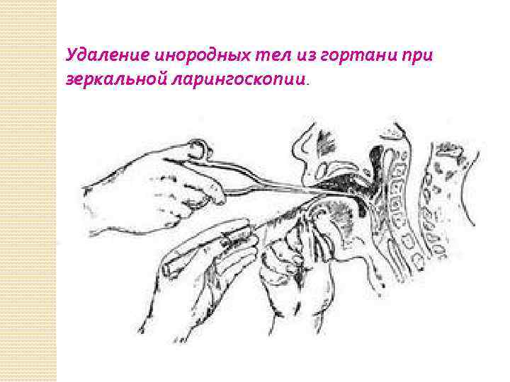 Презентация инородные тела глотки