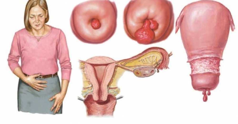 Атрофический кольпит (вагинит) - диагностика, причины, симптомы и лечение | Medline
