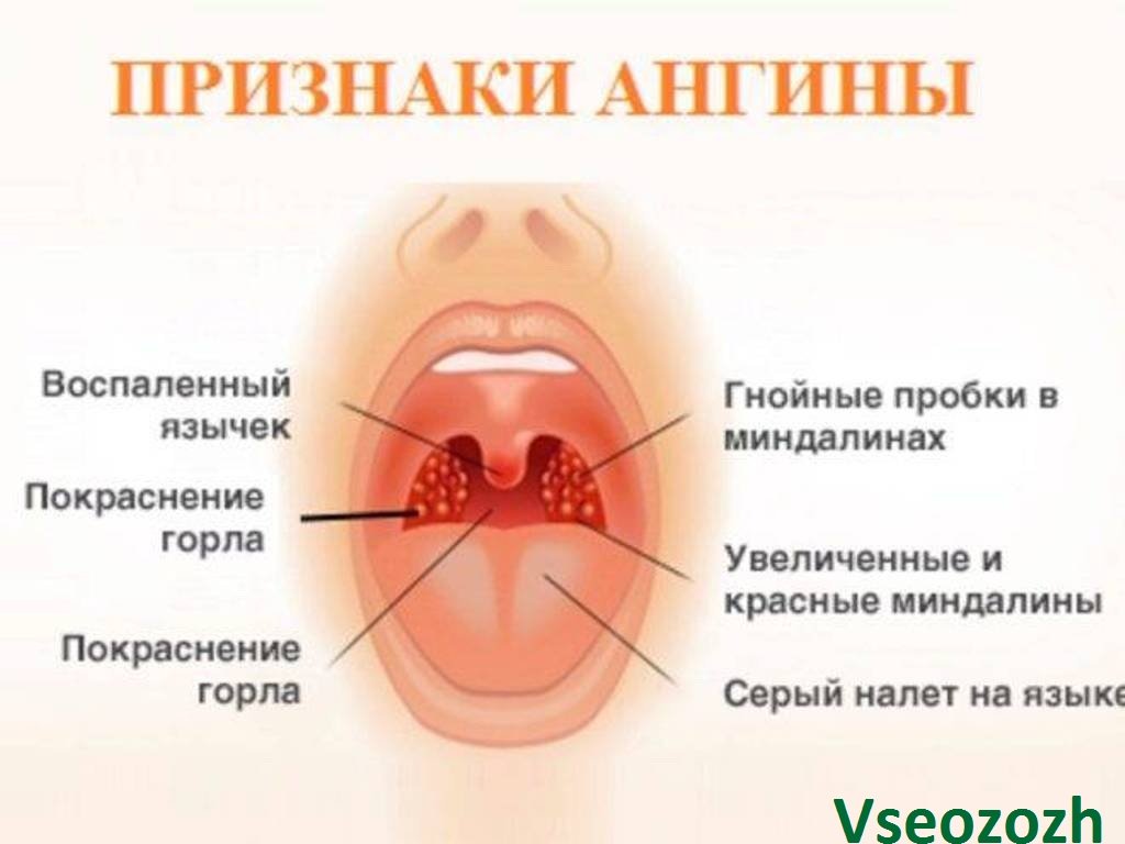 Гнойная ангина карта вызова