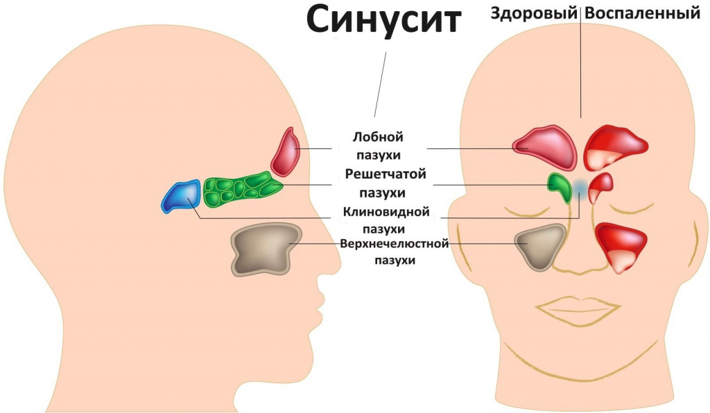 Гайморит: симптомы, причины, диагностика, профилактика и лечение